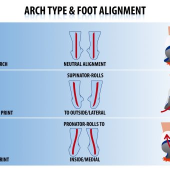 Arch Type And Foot Alignment