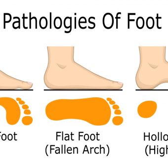Illustration of foot pathologies, such as flat and hollow foot